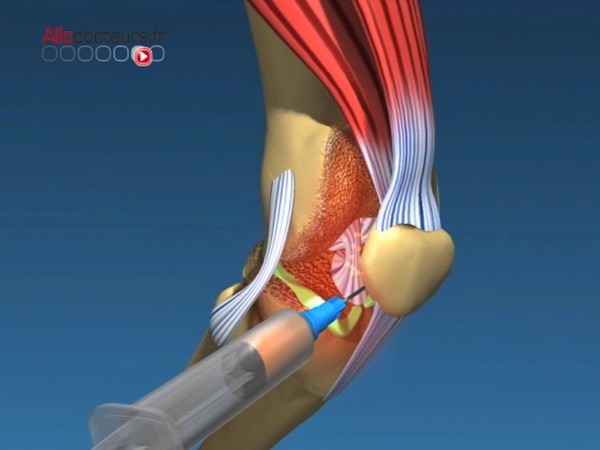 Arthrose l’espoir des cellules souches